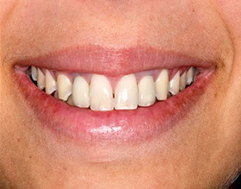Dental-implant-after-768x603