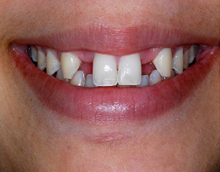 Dental-implant-before-768x603