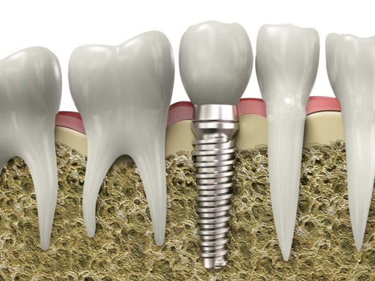 dental-implants-768x576