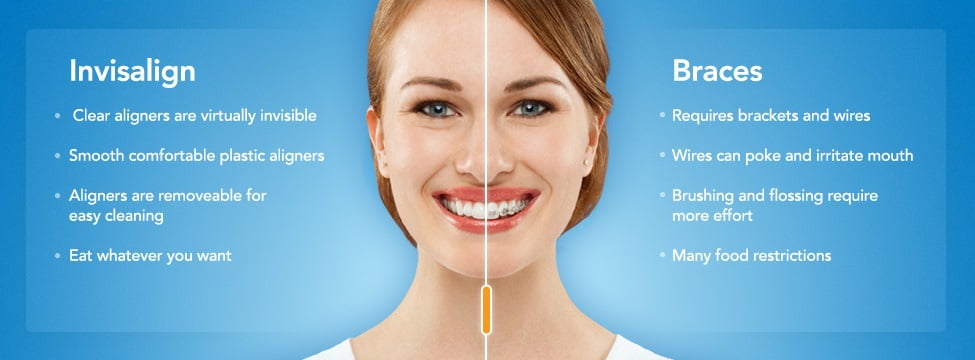 invialign-vs-braces-1