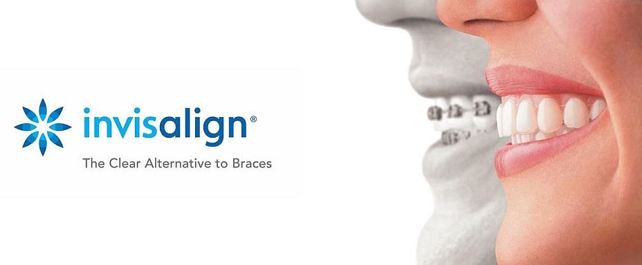 Invisalign® or Clear Braces - Smiles by German Design