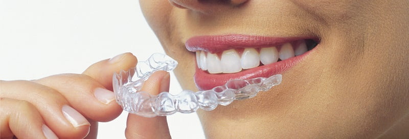 invisalign-wear