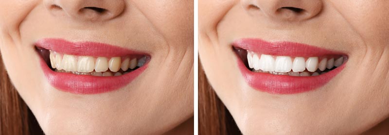 teeth-whitening